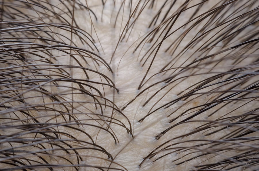Hair Follicles
